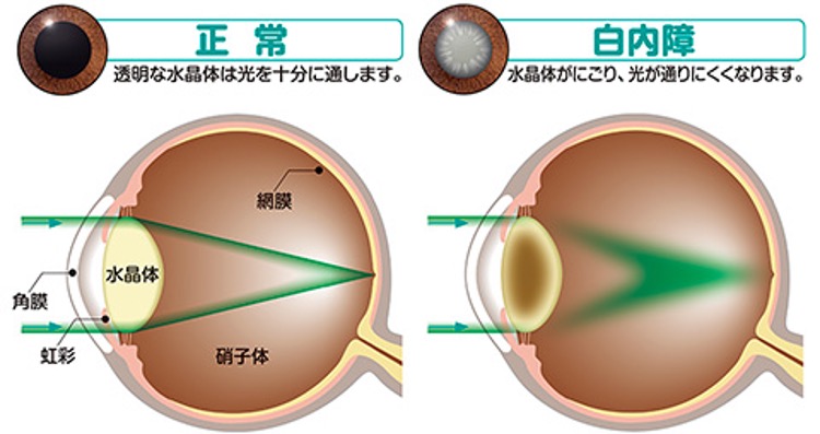 図：白内障の見え方