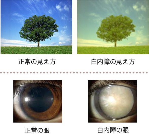写真:白内障の見え方