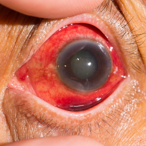 写真:急性緑内障発作