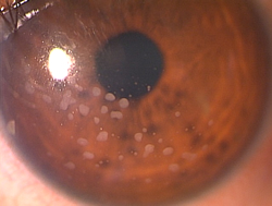 写真：ぶどう膜炎