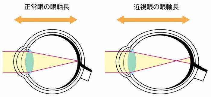 図：眼軸長による違い