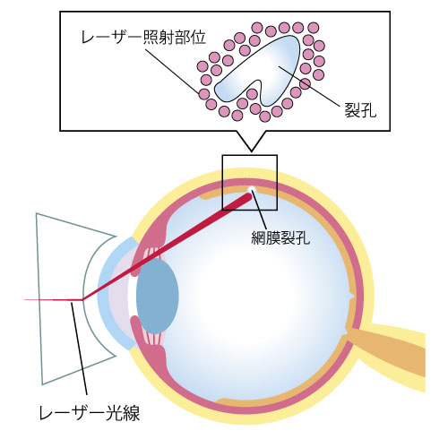 図：レーザー治療の説明