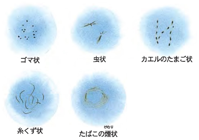 飛蚊症の見え方