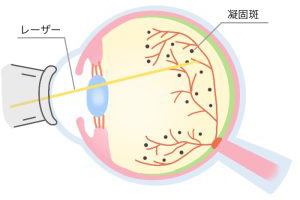 図：レーザー治療