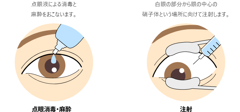 図：硝子体注射