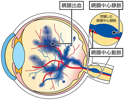 図:網膜中心静脈閉塞症