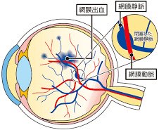 図：網膜静脈分枝閉塞症
