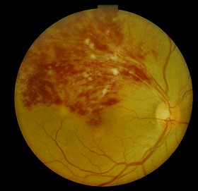 写真：網膜静脈分枝閉塞症