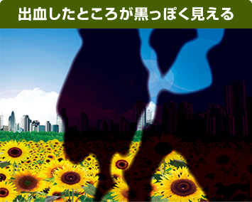 写真:出血したところが黒っぽく見える