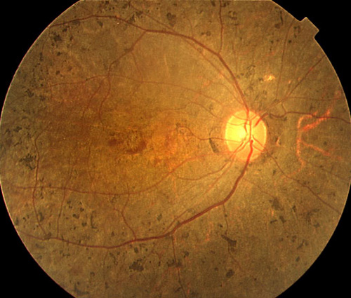 写真:網膜色素変性症