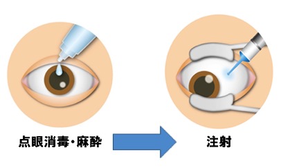 図：硝子体注射